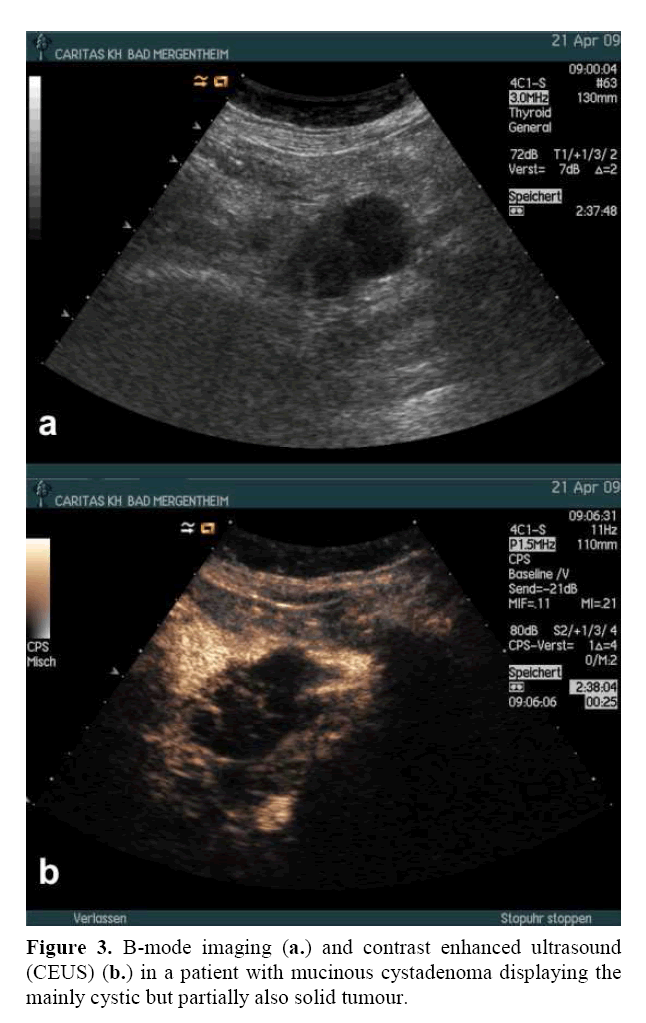 pancreas-mucinous-cystadenoma-displaying