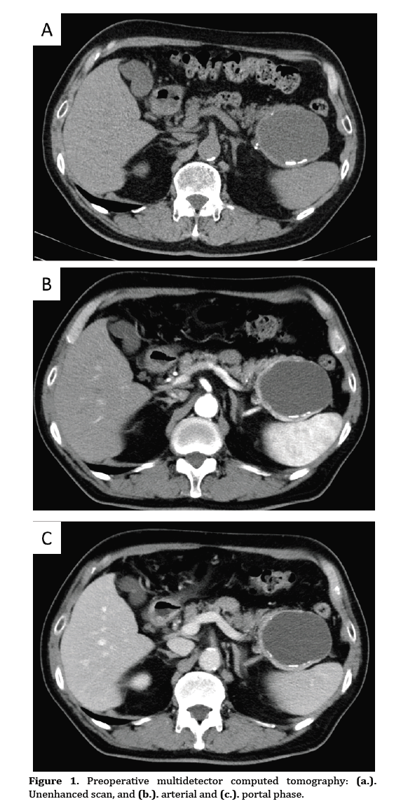 pancreas-multidetector-computed-tomography