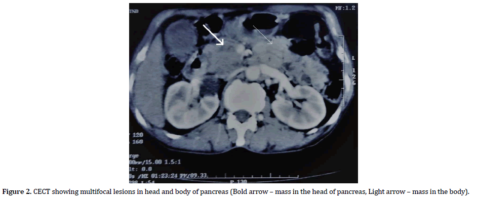 pancreas-multifocal-lesions