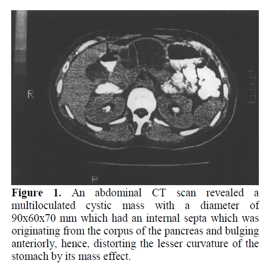 pancreas-multiloculated-cystic-mass