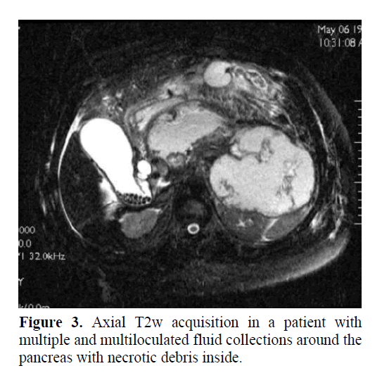 pancreas-multiloculated-fluid-collections