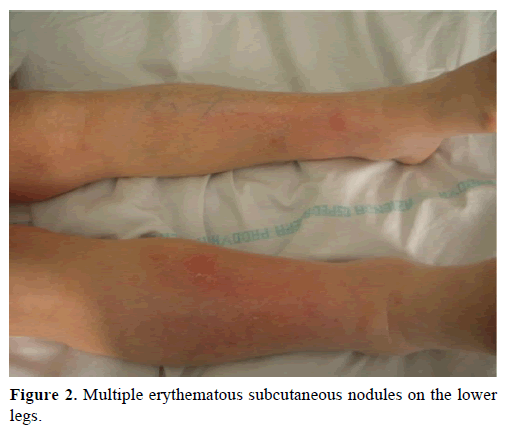 pancreas-multiple-erythematous-subcutaneous