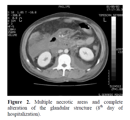 pancreas-multiple-necrotic-areas