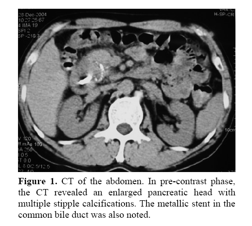 pancreas-multiple-stipple-calcifications