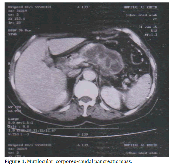 pancreas-mutilocular-corporeo-caudal