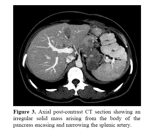 pancreas-narrowing-splenic-artery