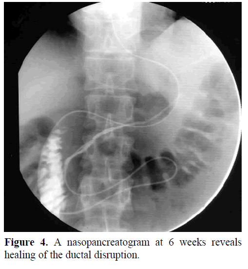 pancreas-nasopancreatogram-ductal