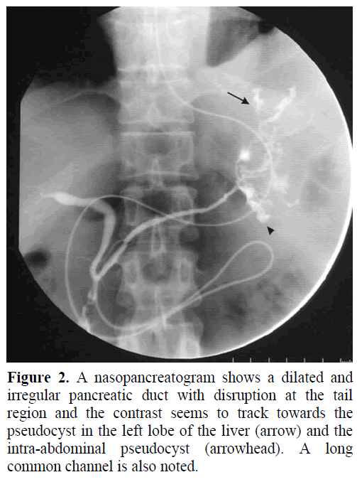 pancreas-nasopancreatogram-irregular