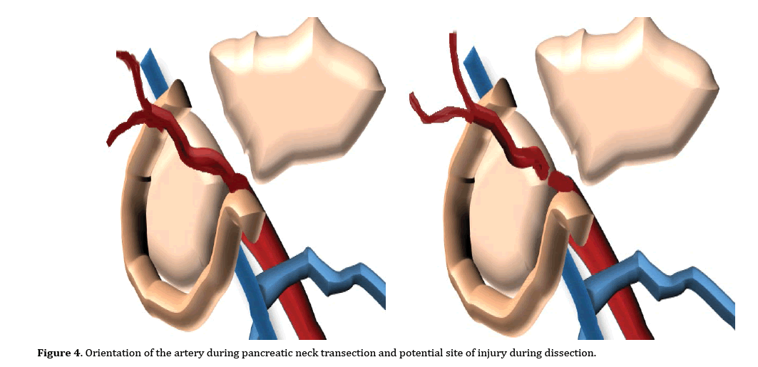 pancreas-neck-transection