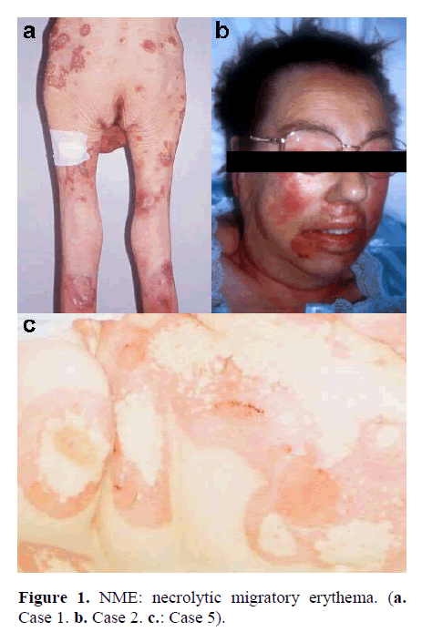 pancreas-necrolytic-migratory-erythema