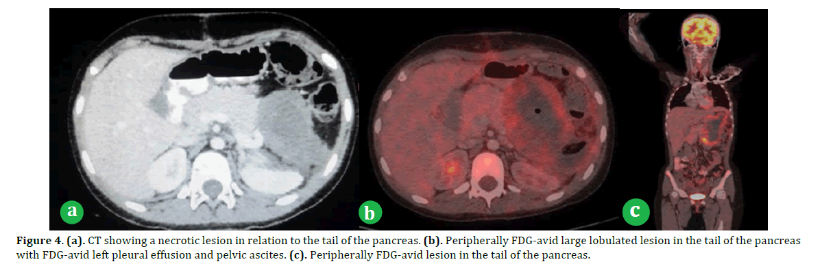 pancreas-necrotic-lesion