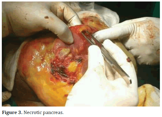 pancreas-necrotic-pancreas