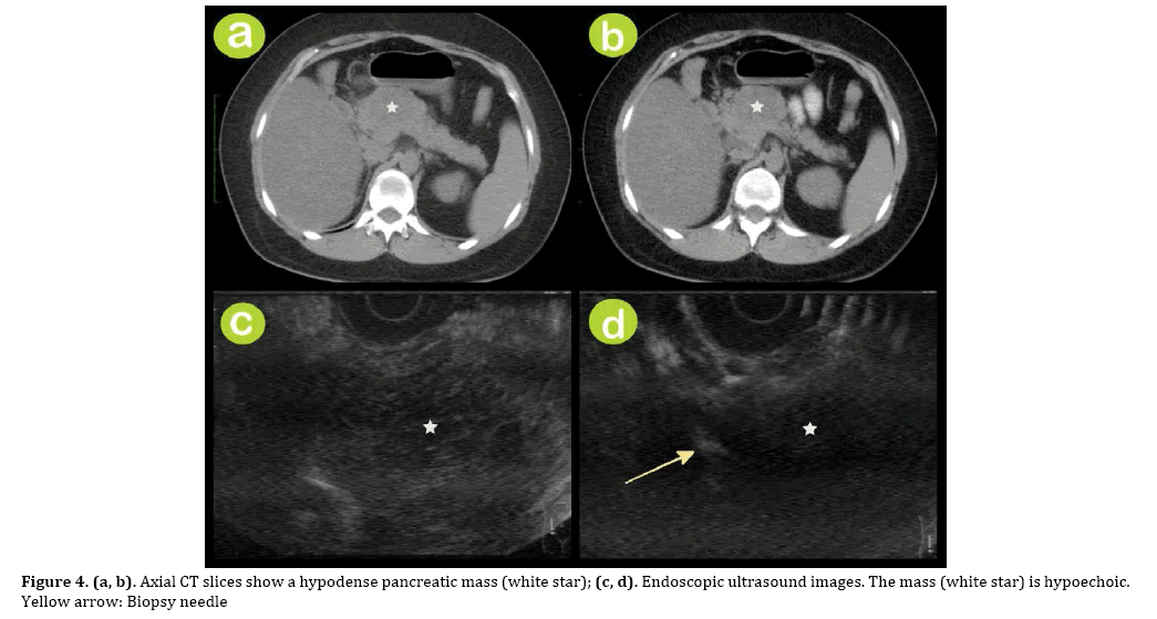 pancreas-needle