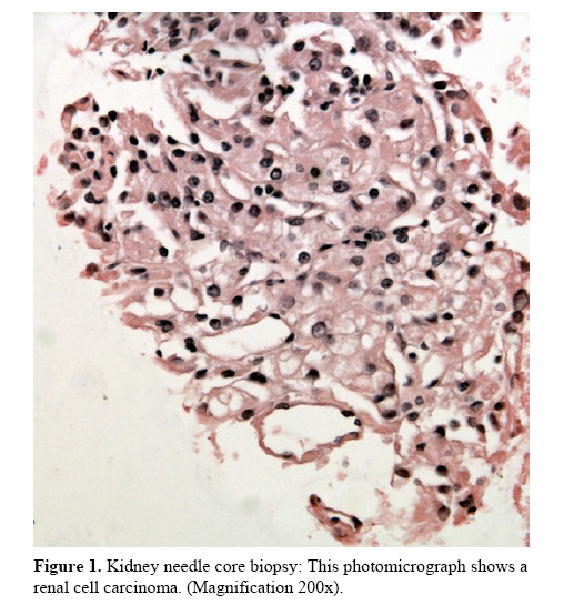 pancreas-needle-core-biopsy