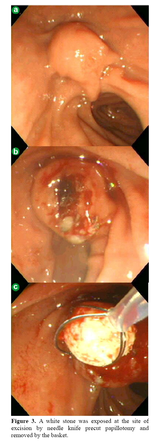 pancreas-needle-knife-precut-papillotomy