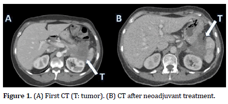 pancreas-neoadjuvant-treatment