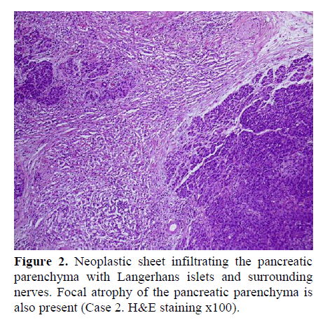 pancreas-neoplastic-sheet-infiltrating