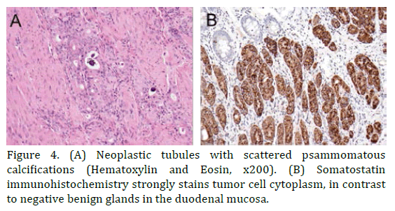 pancreas-neoplastic-tubules