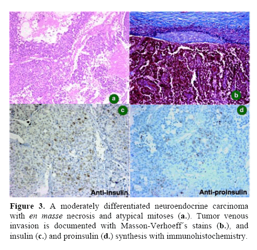 pancreas-neuroendocrine-carcinoma