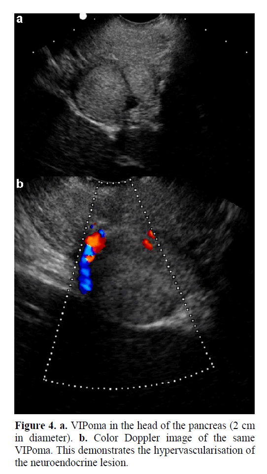 pancreas-neuroendocrine-lesion