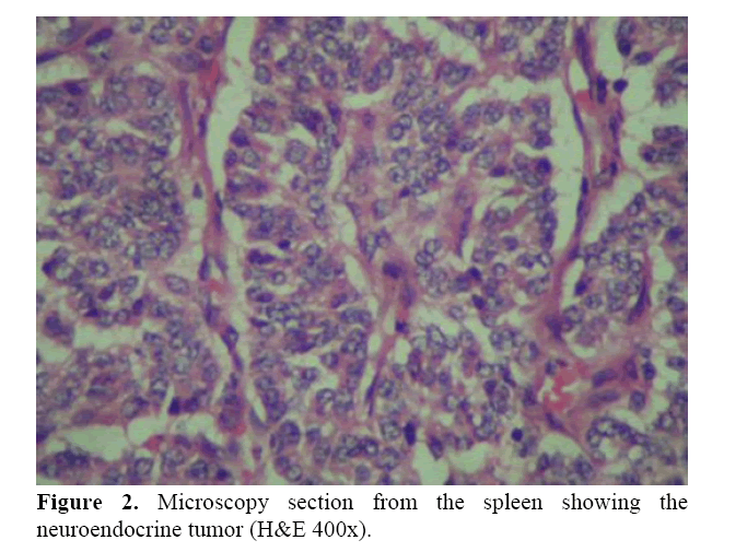 pancreas-neuroendocrine-tumor
