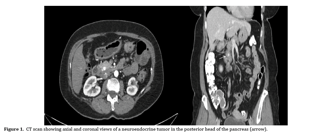 pancreas-neuroendocrine-tumor