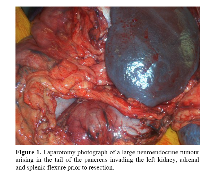 pancreas-neuroendocrine-tumour