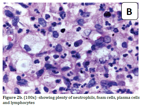 pancreas-neutrophils