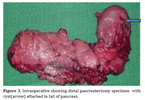 pancreas-pancreatectomy