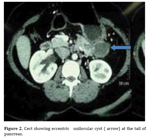 pancreas-unilocular