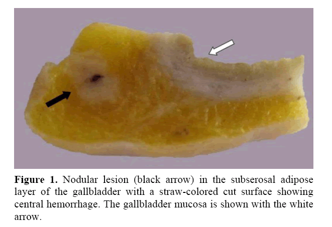 pancreas-nodular-lesion-black-arrow
