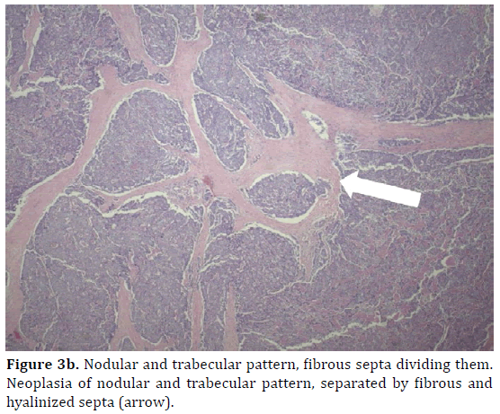 pancreas-nodular-trabecular-pattern