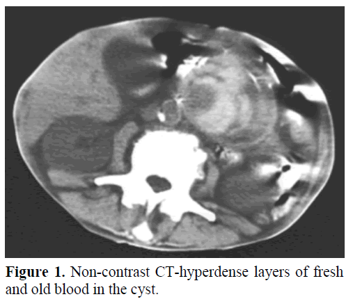 pancreas-non-contrast-ct-hyperdense