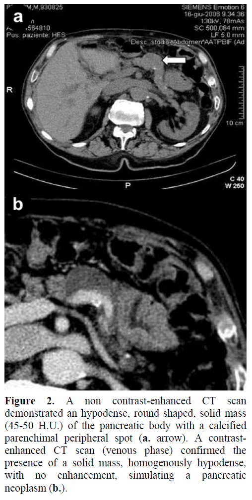 pancreas-non-contrast-enhanced-ct-scan