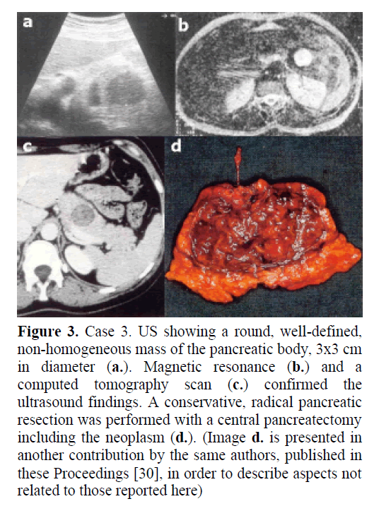 pancreas-non-homogeneous-mass