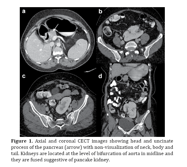 pancreas-non-visualization-neck