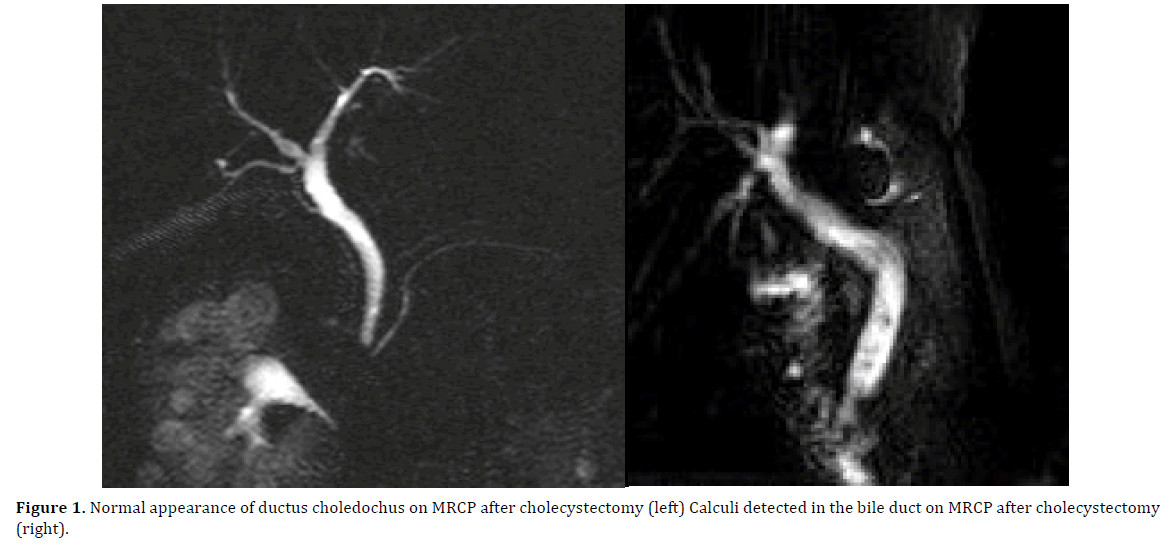 pancreas-normal-appearance-ductus