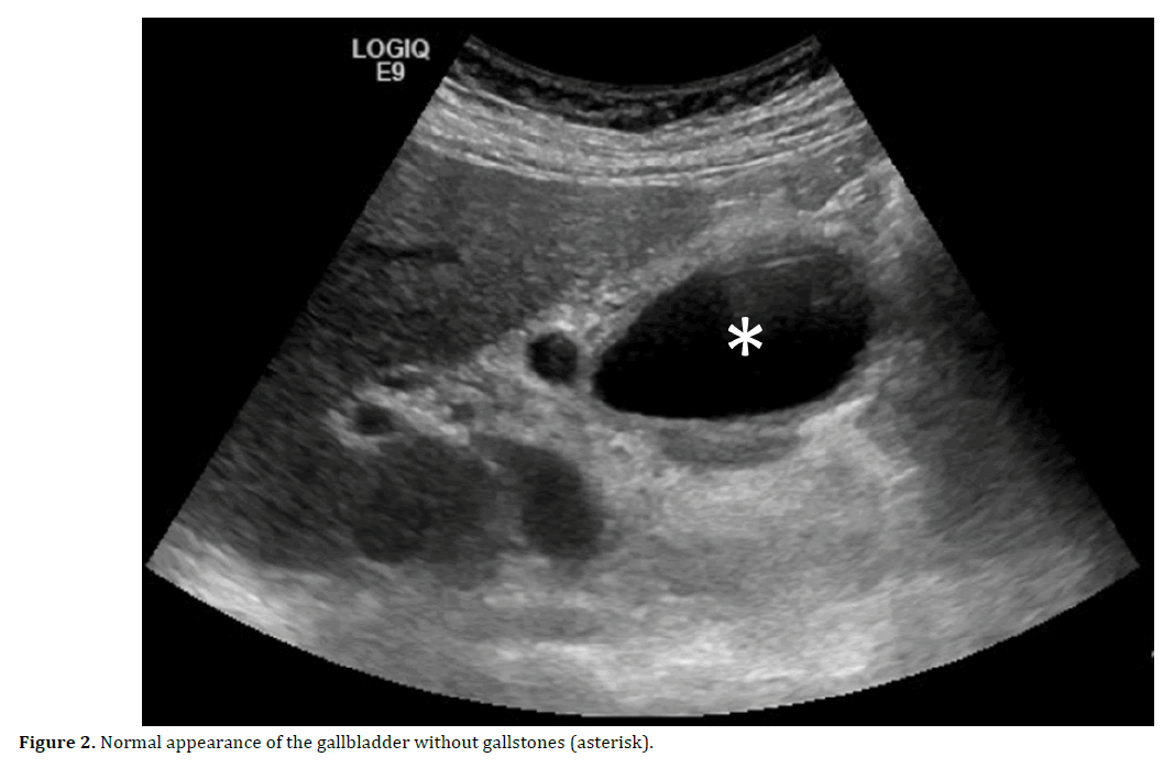 pancreas-normal-appearance-gallstones