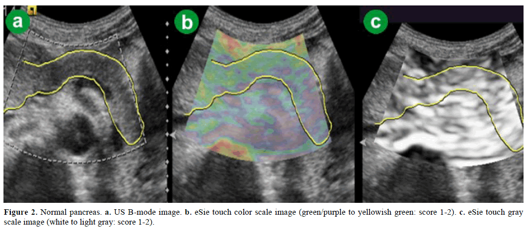 pancreas-normal-pancreas-us-b-mode-image