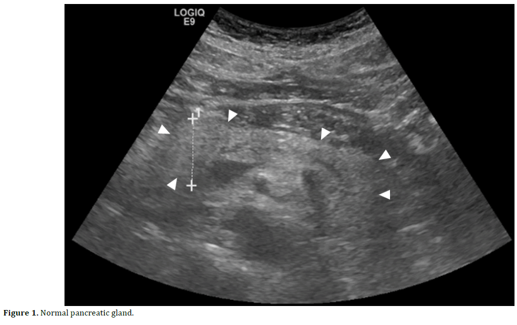 pancreas-normal-pancreatic-gland