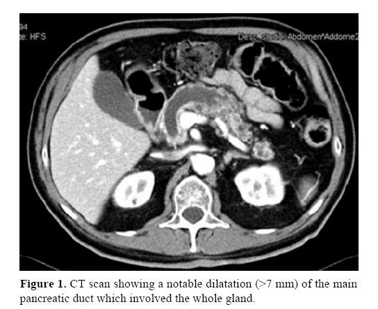 pancreas-notable-dilatation