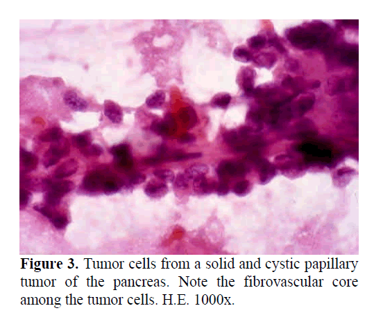 pancreas-note-fibrovascular-core