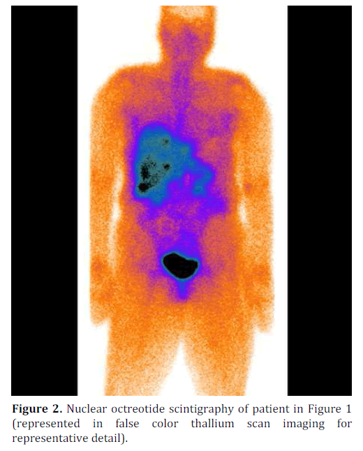 pancreas-nuclear-octreotide-scintigraphy