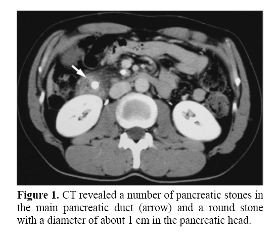 pancreas-number-pancreatic-stones