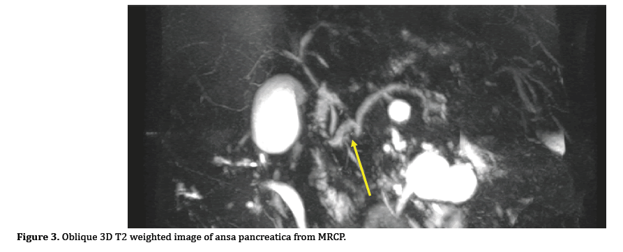 pancreas-oblique