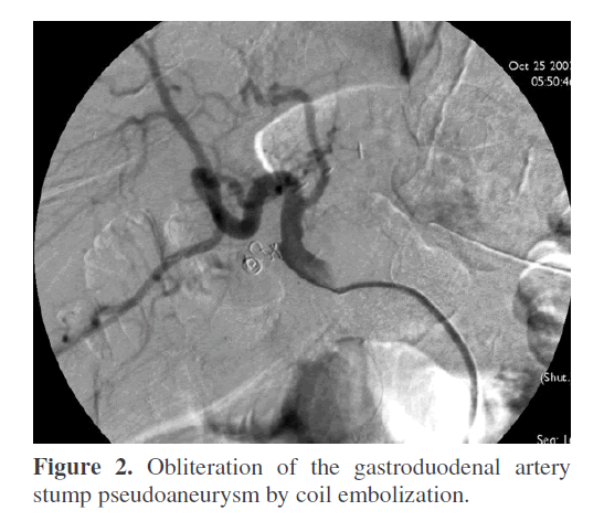 pancreas-obliteration-gastroduodenal