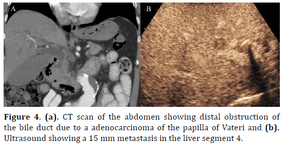 pancreas-obstruction