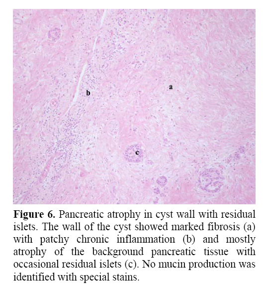 pancreas-occasional-residual-islets