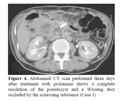 pancreas-occluded-sclerosing-substance