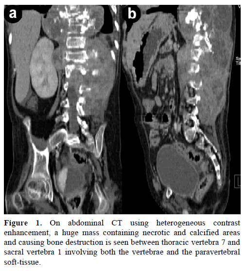 pancreas-on-abdominal-heterogeneous